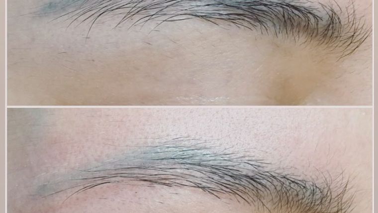 Eyebrow Removal istanbul