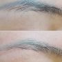 Eyebrow Removal istanbul